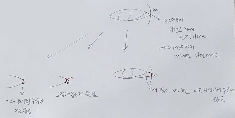 트임을 하고 ㄷ자변형이 오는 이유는?
