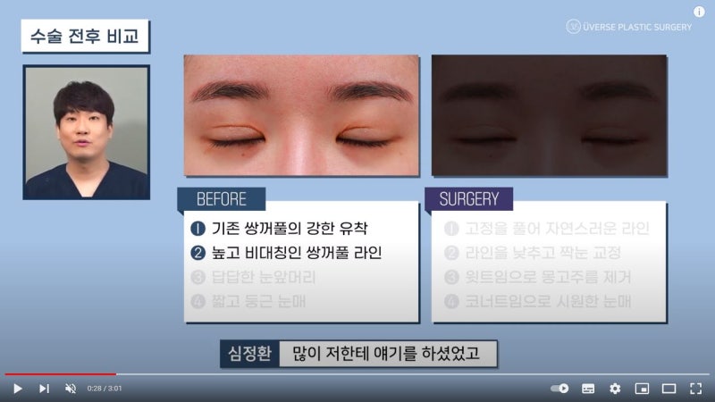 [Weverse Plastic Surgery] ชั้นตาหอยแครง~ แก้ตาสองชั้นให้ดวงตาดูกลมโตสดใส, รอยแผลเป็นลึก/ รอยพับหัวตา/ เปิดหัวตาด้านบน/ เปิดหางตา