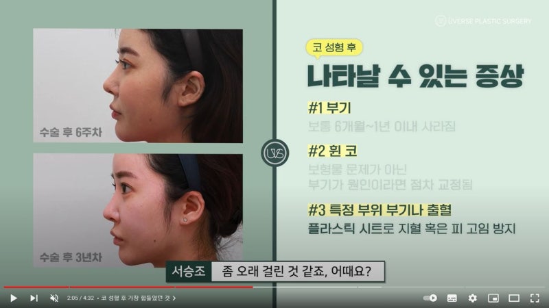[위버스성형외과] 코 재수술 3년 경과 인터뷰! 코 수술 후 부기/ 휜코 등