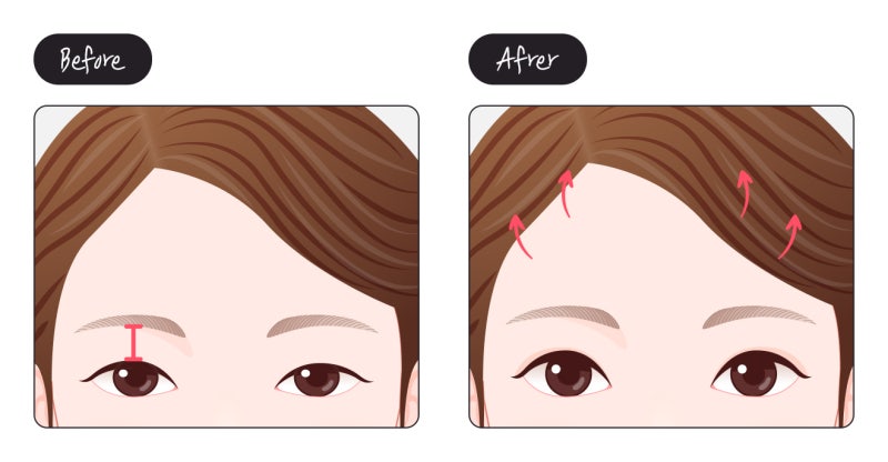 눈두덩이에 눈이 묻혀있는 경우에도 이마거상으로 해결이 될까요?