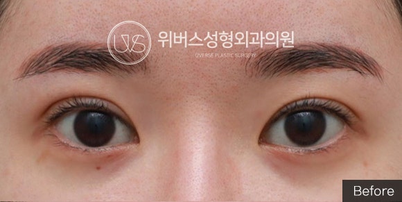 소세지 쌍꺼풀 라인낮추기 & 코너트임