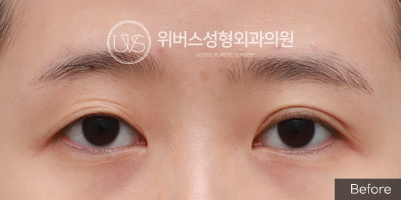[실환 케이스] 절개쌍꺼풀 겹주름, 비대칭, 흉터 재수술