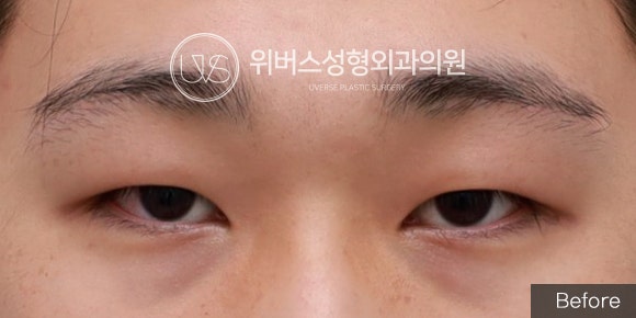 [Real Case] Incisional Double Eyelid, Upper Eyelid Fat Removal (Male Eye Surgery)