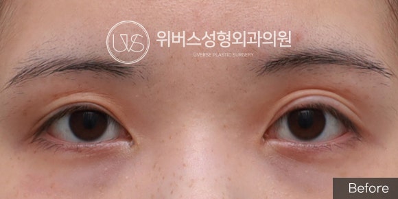 [실환 케이스] 위 눈꺼풀 지방이식 (눈두덩이 지방이식)
