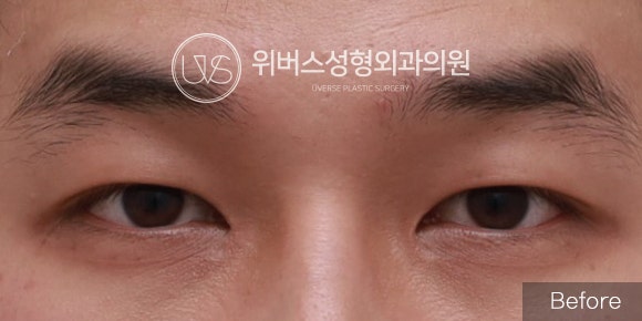 [실환 케이스] 남자 눈 성형 (절개쌍꺼풀,밑트임)