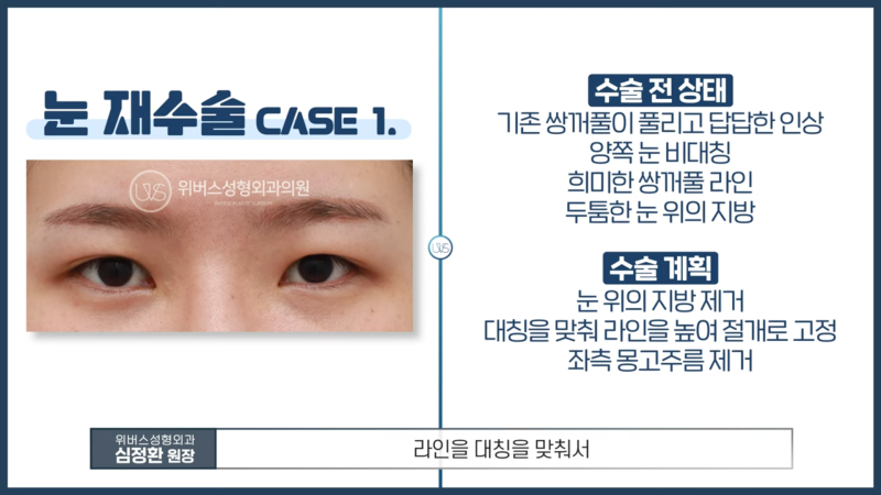 눈재수술 환자 유형별 후기 (비대칭 쌍꺼풀, 소세지 쌍꺼풀)