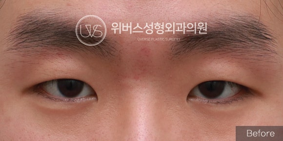[실환 케이스] 남자 눈성형(두꺼운 눈두덩이, 절개 쌍꺼풀, 눈매교정, 앞트임)
