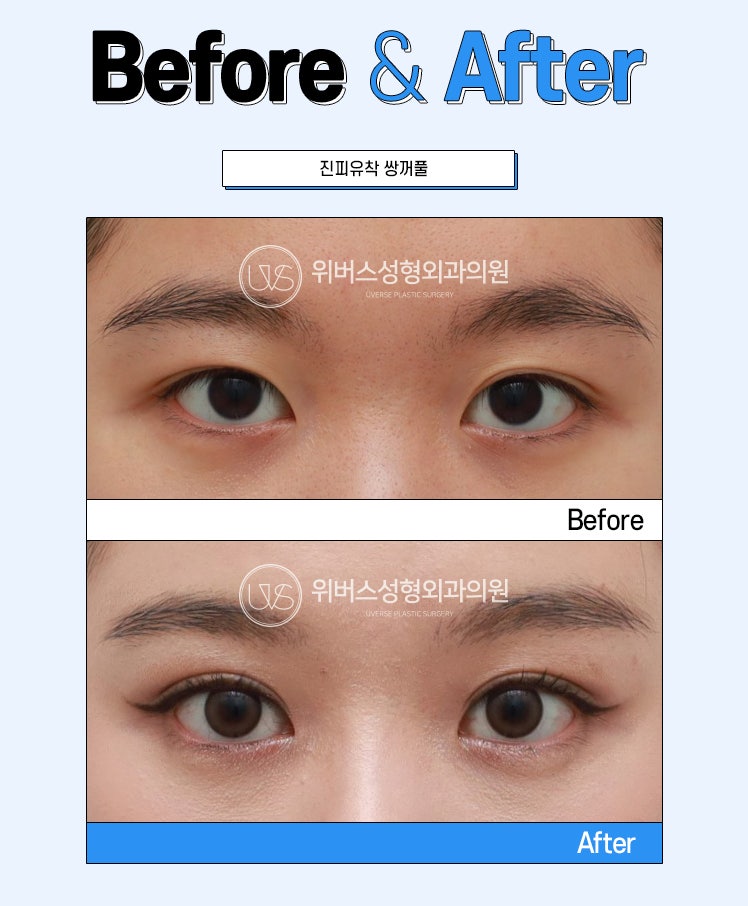 쌍꺼풀 액과 테이프 오래 사용하면, 자연유착으로는 수술 불가능할까?