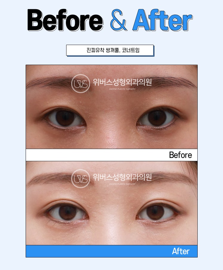눈매교정을 해야 꼭 또렷한 눈이 되는걸까? 눈매교정이 꼭 필요한 경우는?