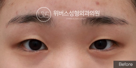 [실환 케이스] 절개쌍꺼풀, 앞트임