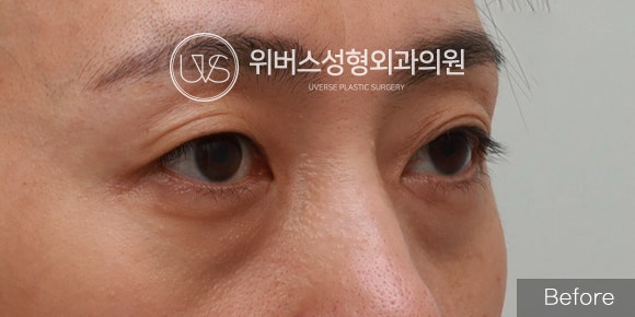 [실환 케이스] 눈밑지방재배치, 앞볼 필러