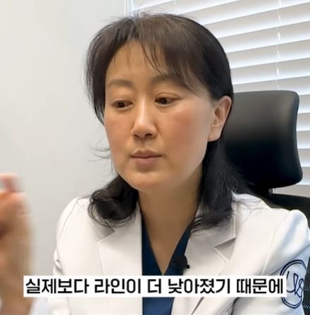 쌍꺼풀 수술 후 라인이 낮아지는 이유