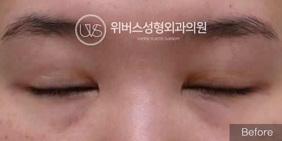 [실환 케이스] 눈재수술(절개쌍꺼풀) + 눈매교정+ 눈밑지방재배치