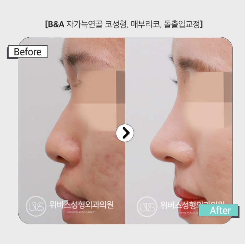 첫 수술에 자가늑 사용 시 나중에 재사용 할 수 있나요?
