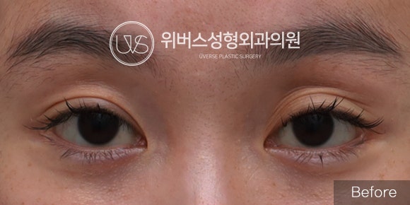 [Real Patient Case] Upper Eyelid Fat Grafting