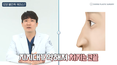 解决鼻型不满意！从鼻尖下垂到修复手术时机全解析！