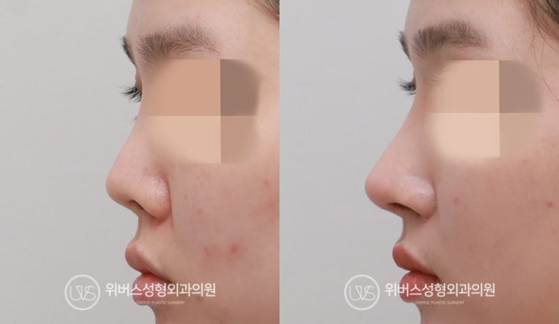 [실환 케이스] 짧은 코, 들린 코, 비주함몰 코재수술