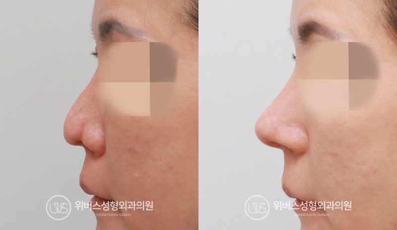[실환 케이스] 자가늑연골 코재수술, 휜코, 비주교정