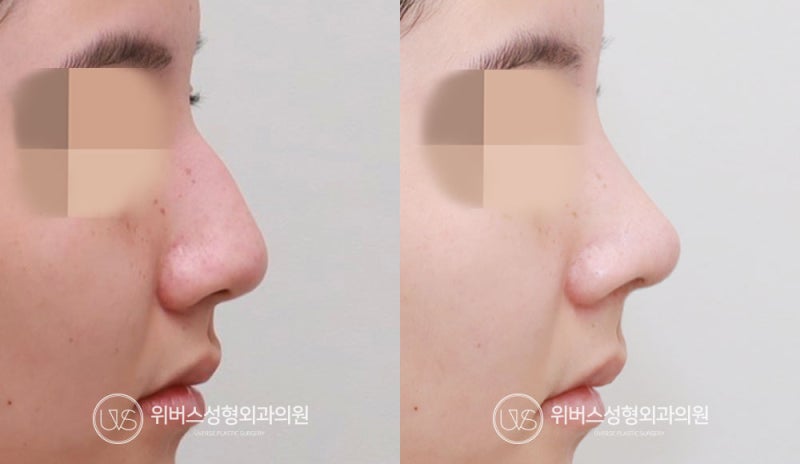 [Ca phẫu thuật thực tế] Nâng mũi không sụn nhân tạo