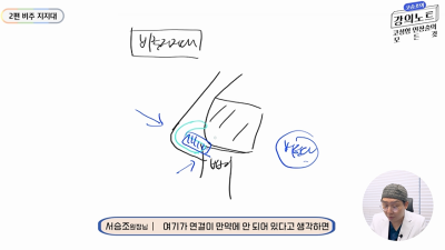 [Dr. Koh Seung-jo's Lecture Notes] Septal Extension Graft Part 2