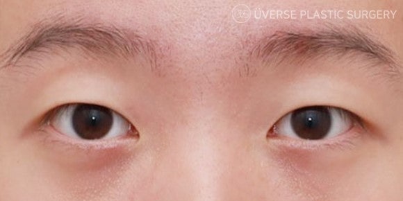 [실환 케이스] 남자 절개 쌍꺼풀, 눈매교정