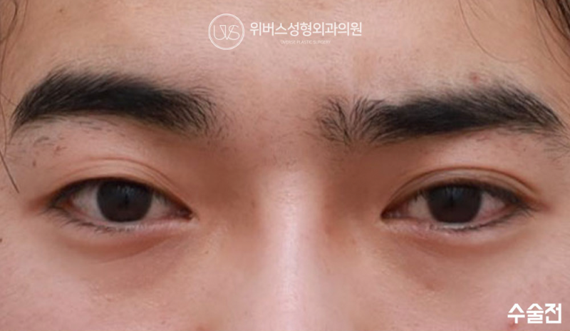 [실환 케이스 리뷰] 남자 눈성형 자연유착, 코너트임