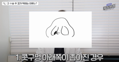 코 수술 후 코 막힘이 왜 생기는 걸까? 코 막힘 해결방법과 예방법은?｜코 부작용 1편
