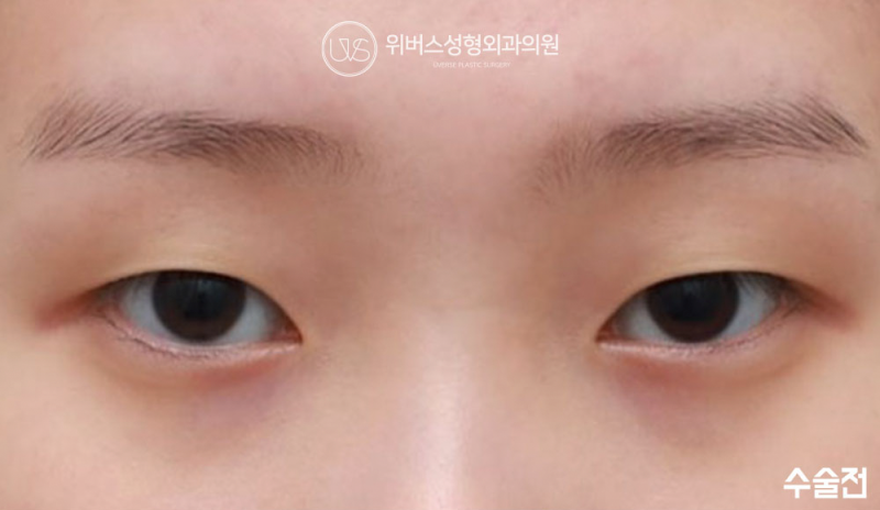 [실환 케이스 리뷰] 자연유착, 눈매교정, 코너트임