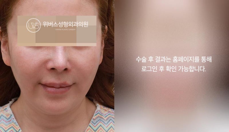 [실환 케이스 리뷰] 미니리프팅, 이중턱 지방흡입&실리프팅