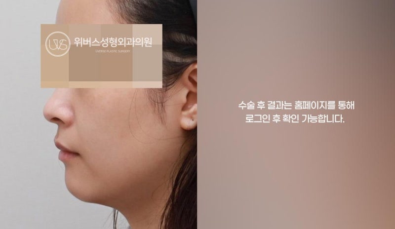 [실환 케이스 리뷰] 코너트임, 눈밑지방 재배치 이중턱 지방흡입, 근육뮦기