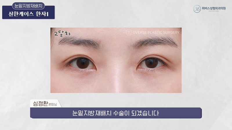 눈 밑 지방재배치 유형별 케이스(실제 수술 전후)