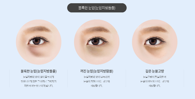 눈밑지방재배치로 다크서클 개선될까? 효과와 한계 총정리