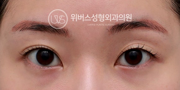자연유착·눈매교정·눈두덩이 지방이식 실제 케이스 리뷰