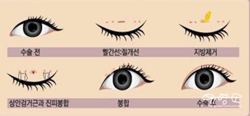 3. Types and Methods of Double Eyelid Surgery