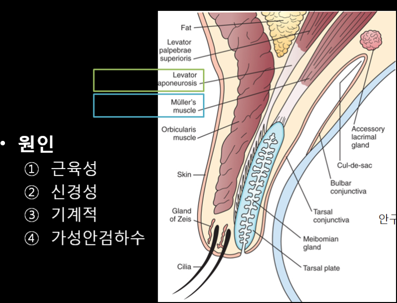 4. What is Ptosis (Droopy Eyelids)?
