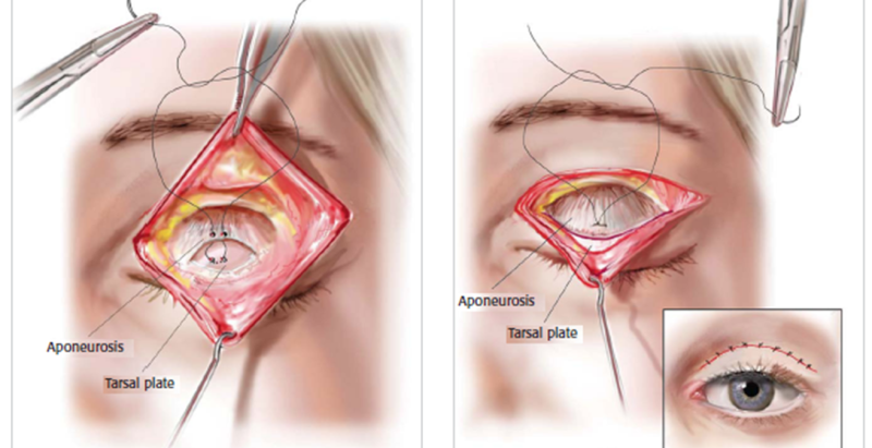 5. Ptosis Correction Surgery (Eyelid Ptosis Correction)