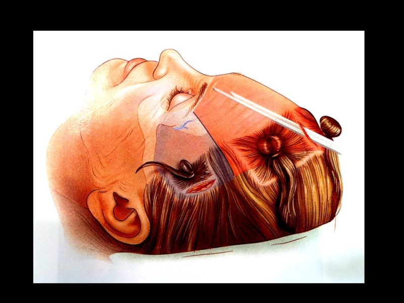 1. Endoscopic Forehead Lift
