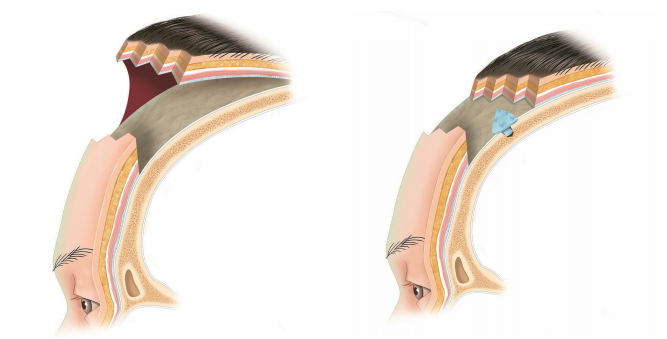 2. Forehead Reduction Surgery