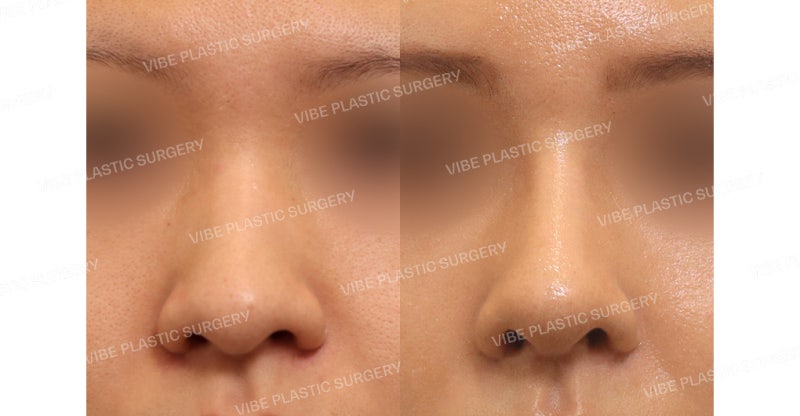 Correction of Hump Nose, Long Nose, Deviated Nose, and Bulbous Nose