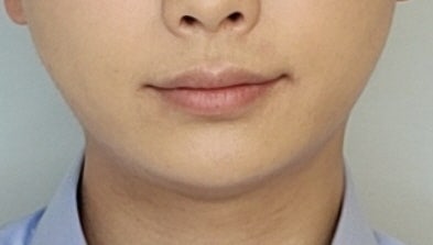 Buccal Fat Removal & Double Chin Liposuction & Chin Implant