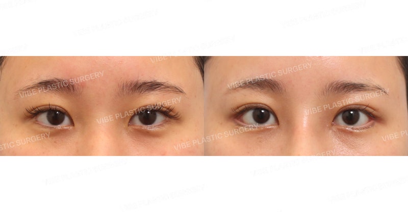 Mango Canthoplasty (Lateral + Lower Canthoplasty, Dual Canthoplasty)