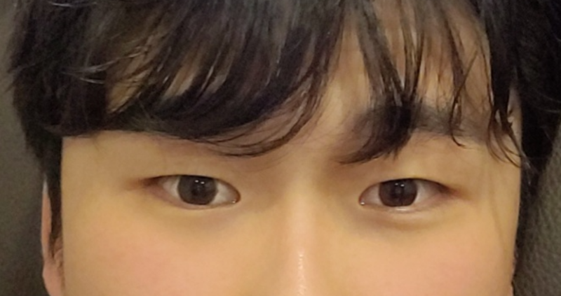 Men's Incisional Ptosis Correction + Mango Canthoplasty