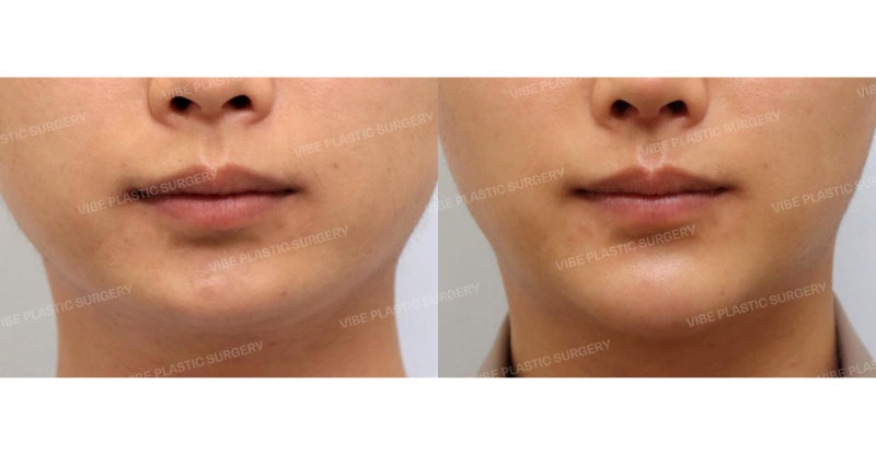 1. Buccal Fat Removal