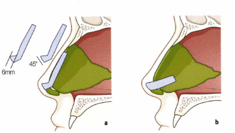 3. Rhinoplasty Surgical Methods