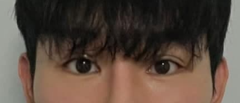Incisional Ptosis Correction and Mango Canthoplasty (Revision Surgery)