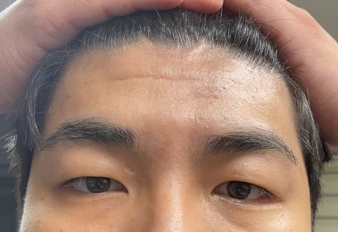 Fix-up Ptosis Correction (Endoscopic Forehead Lift + Incisional Ptosis Correction)