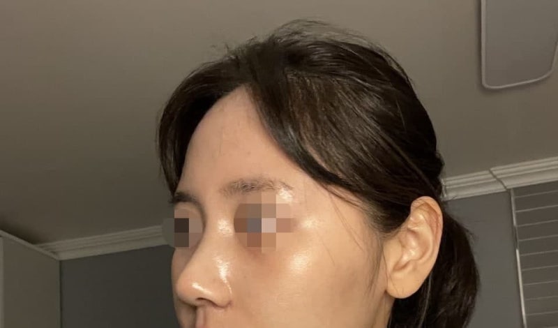 Implant-Free Rhinoplasty (Hump Nose, Bulbous Nose)