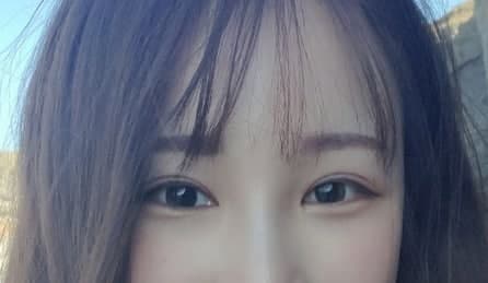 ยกคิ้วผ่านกล้อง (Endoscopic Forehead Lift) + แก้ไขกล้ามเนื้อตาแบบกรีด (ผ่าตัดซ้ำ)