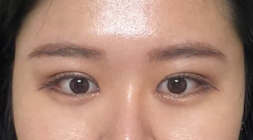 자연유착 재수술, 망고트임 (앞, 뒤, 밑트임)