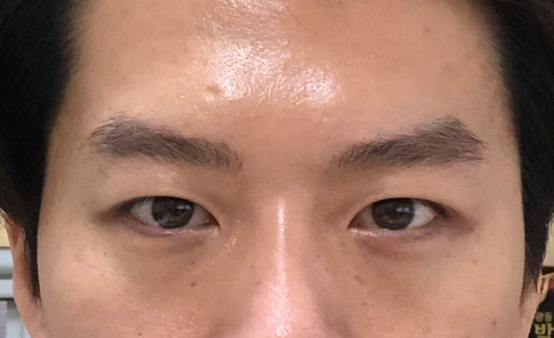 무쌍 눈매교정 & 눈밑 지방 재배치